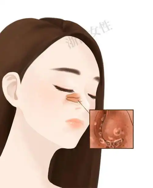 有一种噩梦叫鼻炎,20个问题教你全应对
