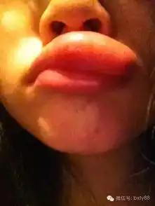 搞笑内涵被蚊子咬成这样,明天怎么出门
