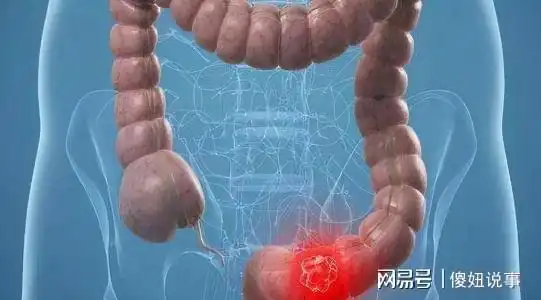 频繁放屁是肠癌的预警吗肿瘤科医生若出现4种症状,尽早检查
