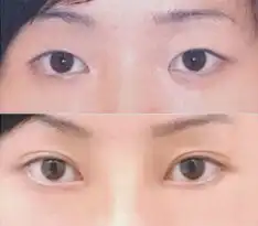 青岛韩式双眼皮需要多少钱
