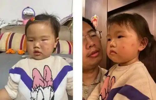 宝宝被蚊子咬成大耳朵图图,又疼又痒还留疤,怎么处理最好
