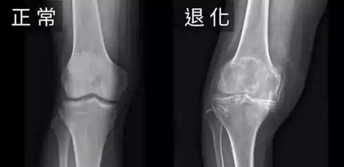 搞懂常见膝关节疾病x光片判读
